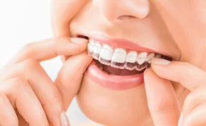 Alinhador transparente Invisalign sendo colocado